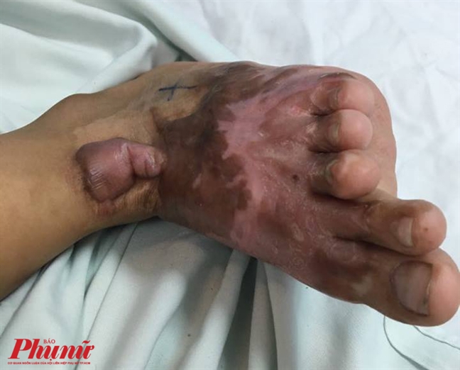 Trẻ phỏng ngày tết, nỗi đau kéo dài đến nhiều năm sau Tre phong ngay tet, noi dau keo dai den nhieu nam sau