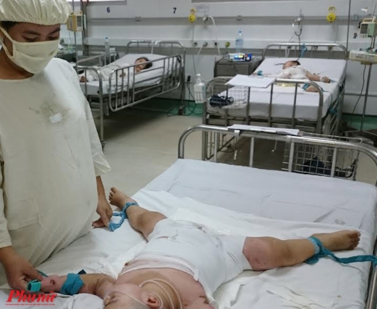 Trẻ phỏng ngày tết, nỗi đau kéo dài đến nhiều năm sau Tre phong ngay tet, noi dau keo dai den nhieu nam sau