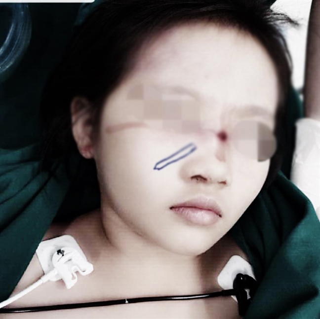 Một học sinh bị bút chì đâm xuyên mũi khi được nghỉ học ăn tết Mot hoc sinh bi but chi dam xuyen mui khi duoc nghi hoc an tet