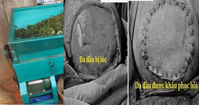 Cuốn mái tóc dài vào máy tuốt tiêu, bé gái bị bong da đầu Cuon mai toc dai vao may tuot tieu, be gai bi bong da dau