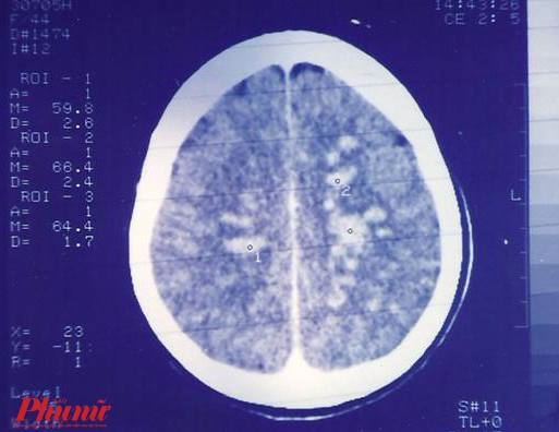 Ngoài sán dải heo, cần cảnh giác với sán dải bò và sán dải cá Ngoai san dai heo, can canh giac voi san dai bo va san dai ca