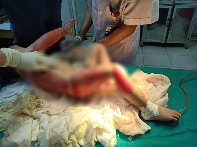Bé trai bỏng gần nửa người vì ngã vào chậu nước tắm Be trai bong gan nua nguoi vi nga vao chau nuoc tam
