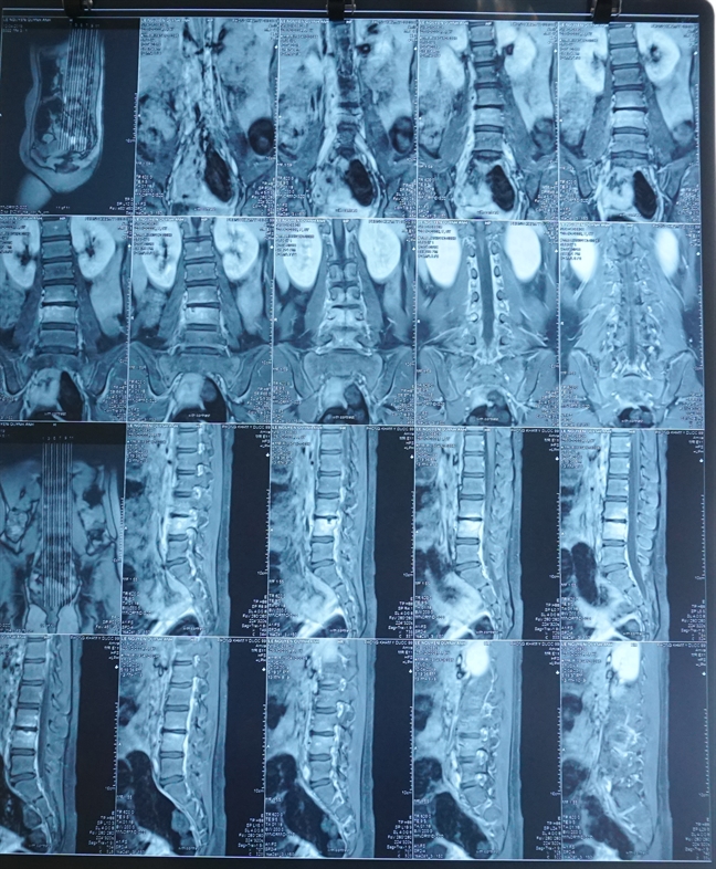 Cứu chữa thành công ca bệnh đau vùng thắt lưng cho bé gái 9 tuổi Cuu chua thanh cong ca benh dau vung that lung cho be gai 9 tuoi