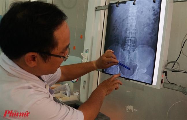 Những biến chứng sau tán sỏi thận không thể xem thường Nhung bien chung sau tan soi than khong the xem thuong