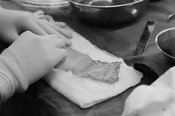 Vết trầy nhỏ trên tay khiến người phụ nữ suy thận sau khi làm thịt heo Vet tray nho tren tay khien nguoi phu nu suy than sau khi lam thit heo