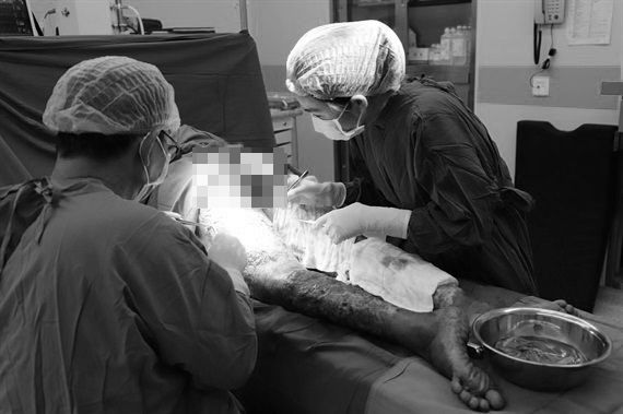 Vết trầy nhỏ trên tay khiến người phụ nữ suy thận sau khi làm thịt heo Vet tray nho tren tay khien nguoi phu nu suy than sau khi lam thit heo