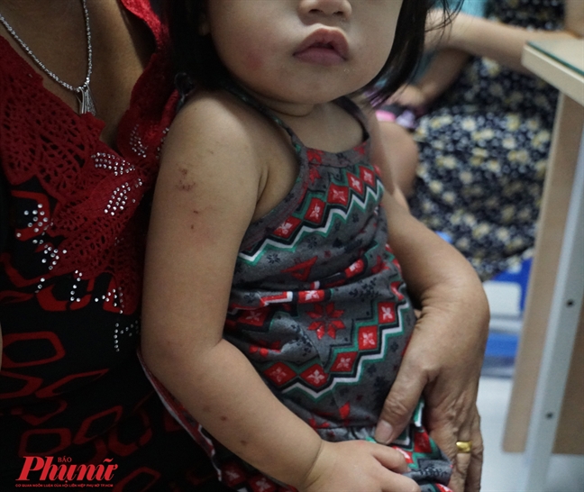 Thời tiết chuyển mùa, nhiều trẻ nguy kịch do viêm cơ tim nhưng cứ ngỡ cảm sốt Thoi tiet chuyen mua, nhieu tre nguy kich do viem co tim nhung cu ngo cam sot