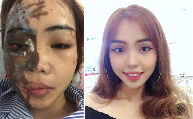 Tạt axit hủy hoại vợ vì ghen: tận cùng cái ác! Tat axit huy hoai vo vi ghen: tan cung cai ac!