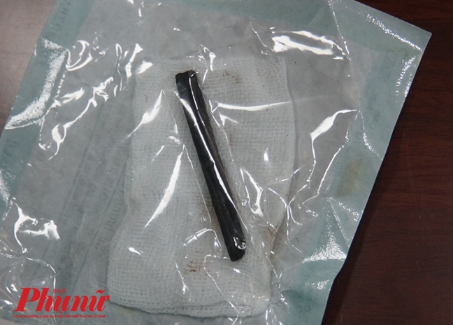 Bị bạn ghim đũa vào hốc mắt 4 năm, người đàn ông không hay biết Bi ban ghim dua vao hoc mat 4 nam, nguoi dan ong khong hay biet