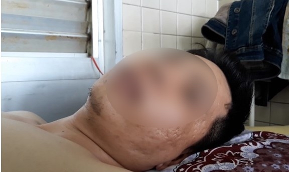 Bệnh viện Chợ Rẫy đình chỉ 2 nhân viên khoan cẳng chân cho bệnh nhân gãy đốt sống ngực Benh vien Cho Ray dinh chi 2 nhan vien khoan cang chan cho benh nhan gay dot song nguc