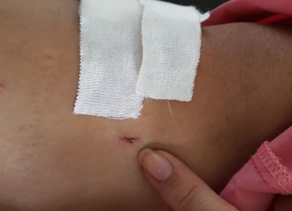 Bệnh viện Chợ Rẫy đình chỉ 2 nhân viên khoan cẳng chân cho bệnh nhân gãy đốt sống ngực Benh vien Cho Ray dinh chi 2 nhan vien khoan cang chan cho benh nhan gay dot song nguc