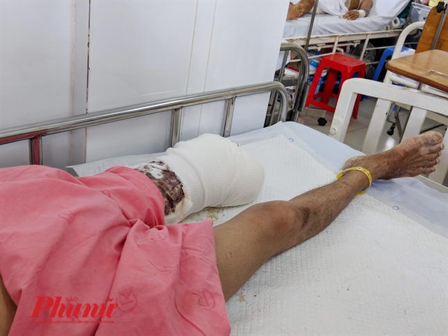 Ám ảnh những người đàn ông khỏe mạnh bị cắt hết chân tay do điện cao thế Am anh nhung nguoi dan ong khoe manh bi cat het chan tay do dien cao the
