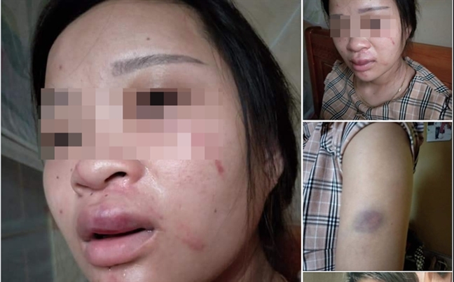 Vợ bầu 8 tháng bị chồng đánh sưng môi chỉ vì đôi giày mua qua mạng Vo bau 8 thang bi chong danh sung moi chi vi doi giay mua qua mang
