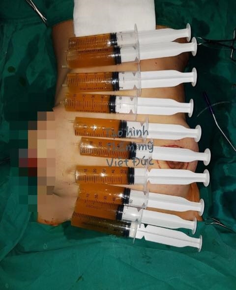 Con vừa cai sữa, mẹ đi nâng ngực dẫn đến biến dạng như bóng bay sắp nổ Con vua cai sua, me di nang nguc dan den bien dang nhu bong bay sap no