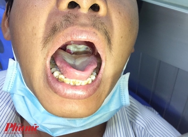 Bạch hầu là bệnh gì khiến bé 6 tuổi ở Đắk Lắk tử vong? Bach hau la benh gi khien be 6 tuoi o Dak Lak tu vong?