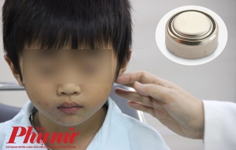 Bé trai thủng màng nhĩ vì viên pin trong đồ chơi hình quả trứng Be trai thung mang nhi vi vien pin trong do choi hinh qua trung
