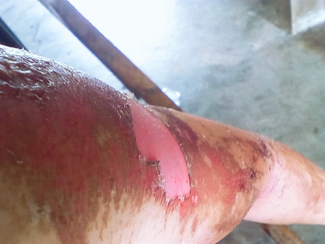 Làm trắng da bằng kem trộn, kem lột: đẹp cấp tốc nhưng… chết từ từ Lam trang da bang kem tron, kem lot: dep cap toc nhung… chet tu tu