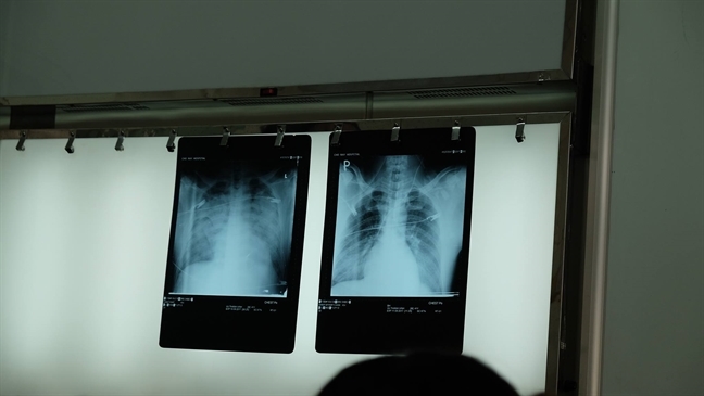Bệnh nhân bị ăn mòn cánh mũi bởi căn bệnh truyền nhiễm nguy hiểm tưởng đã 'lãng quên' Benh nhan bi an mon canh mui boi can benh truyen nhiem nguy hiem tuong da 'lang quen'