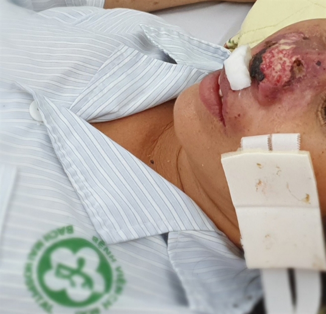Bệnh nhân bị ăn mòn cánh mũi bởi căn bệnh truyền nhiễm nguy hiểm tưởng đã 'lãng quên' Benh nhan bi an mon canh mui boi can benh truyen nhiem nguy hiem tuong da 'lang quen'