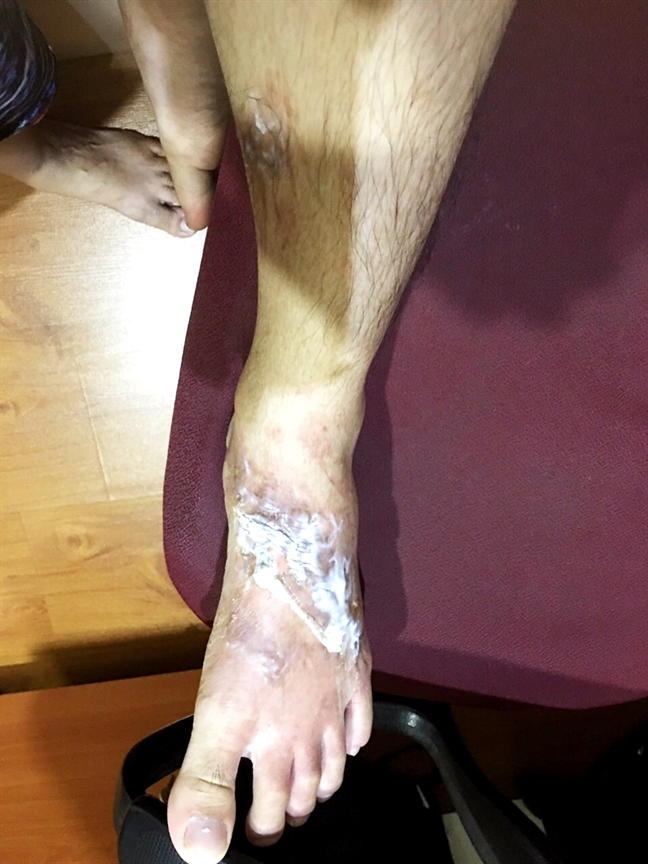 Phỏng độ 2 vì nước thông cống đổ xuống chân Phỏng dọ 2 vì nuóc thong cóng dỏ xuóng chan