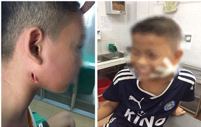 Sức khỏe của nữ bệnh nhân mắc bệnh Whitmore bị ăn mòn cánh mũi giờ ra sao? Suc khoe cua nu benh nhan mac benh Whitmore bi an mon canh mui gio ra sao?