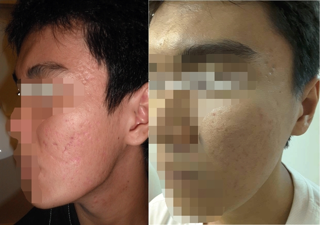 Giao lưu trực tuyến: Điều trị sẹo xấu Giao luu truc tuyen: Dieu tri seo xau