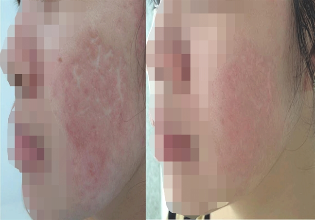 Giao lưu trực tuyến: Điều trị sẹo xấu Giao luu truc tuyen: Dieu tri seo xau