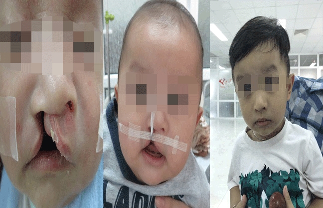 Hành trình mẹ đưa con trai chữa sứt môi từ trong bào thai đến khi thành 'hot boy' Hanh trinh me dua con trai chua sut moi tu trong bao thai den khi thanh 'hot boy'