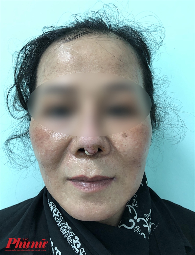 Căng da mặt níu kéo tuổi xuân, chưa kịp trẻ đã liệt mặt Cang da mat niu keo tuoi xuan, chua kip tre da liet mat