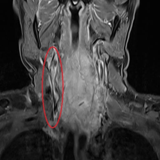 Cắt lể nặn máu độc ra ngoài, bệnh nhân nhiễm trùng máu nguy kịch Cat le nan mau doc ra ngoai, benh nhan nhiem trung mau nguy kich