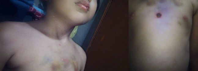 Vụ bé gái bị châm tàn thuốc dã man: Cha dượng - hai từ ám ảnh Vu be gai bi cham tan thuoc da man: Cha duọng - hai tù ám ảnh