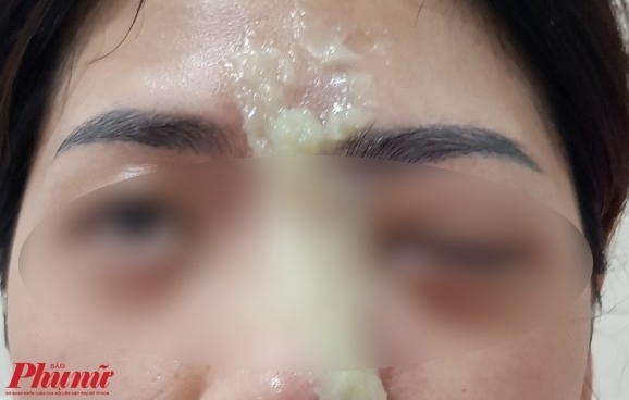 2 phụ nữ bị mù sau khi tiêm filler làm đẹp 2 phu nu bi mu sau khi tiem filler lam dep