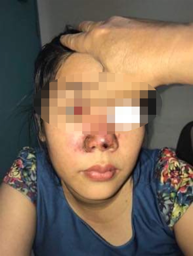 Chàng trai đi làm đẹp bất ngờ bị mù mắt, hư mũi Chang trai di lam dep bat ngo bi mu mat, hu mui