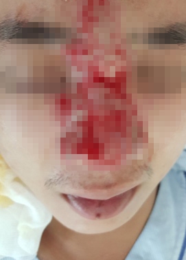 Chàng trai đi làm đẹp bất ngờ bị mù mắt, hư mũi Chang trai di lam dep bat ngo bi mu mat, hu mui