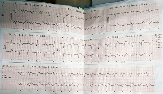 Bệnh nhân xuất hiện cảm giác như ai bóp cổ sau khi bị ong chích Benh nhan xuat hien cam giac nhu ai bop co sau khi bi ong chich