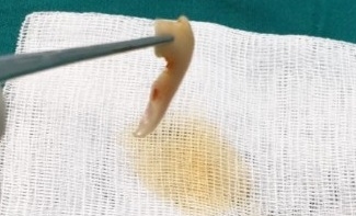 Tạo hình mũi thành công cho bé gái 5 tuổi sau khi bị người nhà vứt vào thùng rác Tao hinh mui thanh cong cho be gai 5 tuoi sau khi bi nguoi nha vut vao thung rac