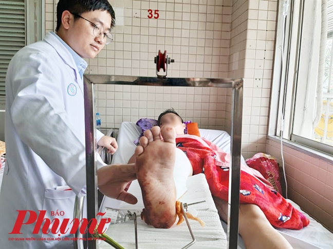 Phó công an xã bị trộm tông thẳng xe vào người khiến chân gãy nhiều đoạn Pho cong an xa bi trom tong thang xe vao nguoi khien chan gay nhieu doan