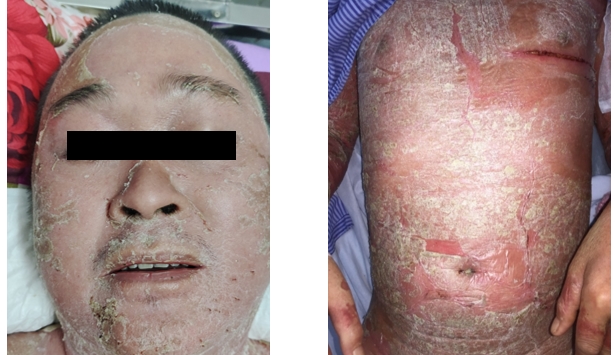Tiêm thuốc ở phòng khám tư, bệnh nhân bong hết da Tiem thuoc o phong kham tu, benh nhan bong het da
