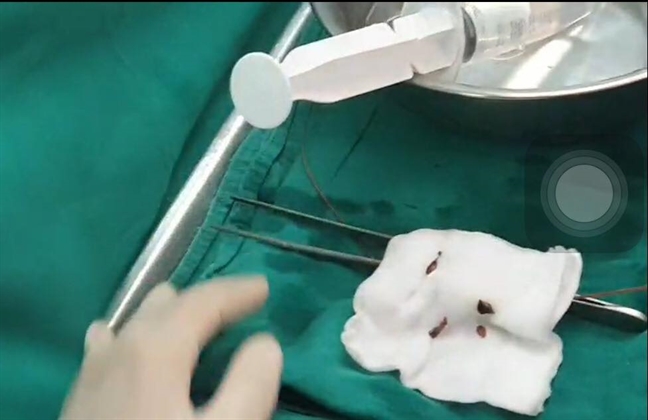 Đến bệnh viện khám đau bụng, bệnh nhân tá hỏa phát hiện hàng ngàn con sán lá gan Den benh vien kham dau bung, benh nhan ta hoa phat hien hang ngan con san la gan