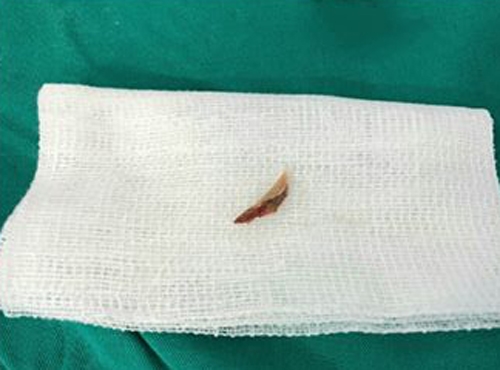 Cứu bé trai bị xẹp phổi sau khi ăn cháo gà Cuu be trai bi xep phoi sau khi an chao ga