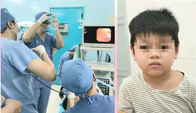 Cứu bé trai bị xẹp phổi sau khi ăn cháo gà Cuu be trai bi xep phoi sau khi an chao ga